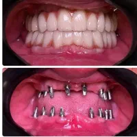 شرایط ویژه جشنواره دندانپزشکی ایمپلنت و اوردنچر|خدمات آرایشگری و زیبایی|آذرشهر, |دیوار