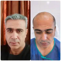 کاشت مو و ابرو و ریش