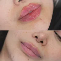 آف 5 روزه تزریق چربی ژل لب چال لپ هیدن چال گونه