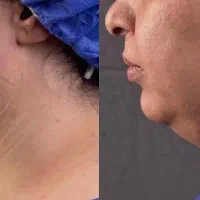 ساکشن غبغب ۳/۵۰۰تومن|خدمات آرایشگری و زیبایی|مشهد, فرهنگ|دیوار