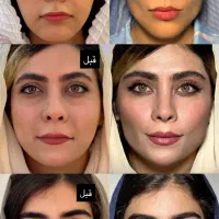جشنواره تابستانه تزریق ژل، بوتاکس و...|خدمات آرایشگری و زیبایی|تهران, فرمانیه|دیوار