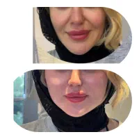 زاویه سازی فک وچربی|خدمات زیبایی و سلامت|اهواز, کیانپارس |دیوار