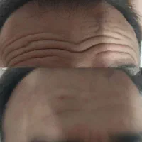 ژل و بوتاکس با تخفیف ویژه(خانم ها و آقایان)