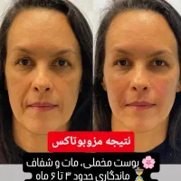 مدل بوتاکس و مزوبوتاکس ویژه بانوان و آقایان