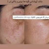 لیزر موهای زائد فول بادی ۴۹۰ تومان|خدمات آرایشگری و زیبایی|رشت, گلسار|دیوار