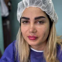 کاشت مو و کاشت ابرو