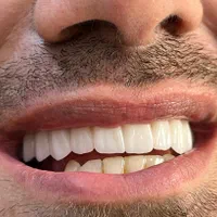 ایمپلنت وکامپوزیت دندونپزشکی|خدمات آرایشگری و زیبایی|تهران, آهنگ|دیوار