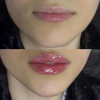 فیلر لب ، خط خنده، زاویه ، مزو فقط ۱۸۰۰