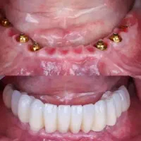 مرکزفوق تخصصی ایمپلنت دیجیتال/فوری/سبک کاخ لبخند|خدمات زیبایی و سلامت|مشهد, احمدآباد|دیوار