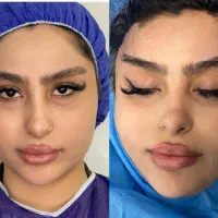 جراحی لیفت شقیقه دایرکت ابرو و تحتانی بخیه لیزری|خدمات زیبایی و سلامت|تهران, ایوانک|دیوار
