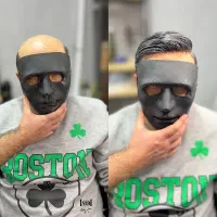 پروتز حرفه ای مو