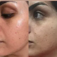 فیشیال، پلاژن تراپی، مزونیدلینگ. جوان ساز