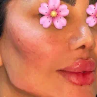 ژل و بوتاکس|خدمات آرایشگری و زیبایی|شیراز, شهرک مهدی‌آباد|دیوار