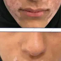 درمان بیماری پیسی و پسوریازیس