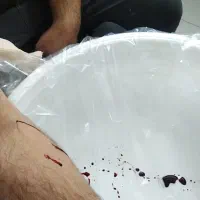 حجامت. فصد. زالو درمانی.|خدمات آرایشگری و زیبایی|مشهد, شاهد (شهرک غرب)|دیوار