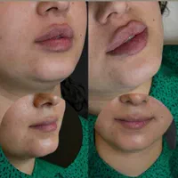 تزریق ژل لب ب روش روسی آنباکسش توسط زیباجو
