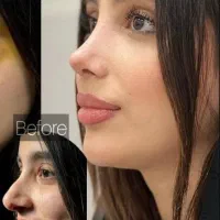 جراحی بینی ابدو ساکشن پروتز مامو عمل بینی تخفیف