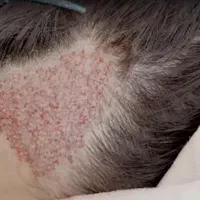 اقساطی مو ، ابرو و ریش بکار
