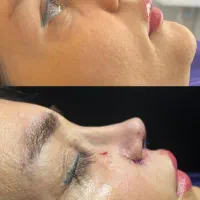 آف ویژه زیبایی بینی