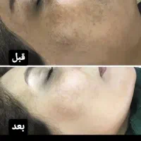 درمان لک صورت تضمینی