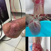 کلینیک تخصصی درمان انواع زخم(بستر و دیابت) فردوس|خدمات آرایشگری و زیبایی|اصفهان, محله سفلی|دیوار