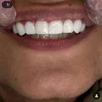 کامپوزیت و روکش برای دندانهای شکسته