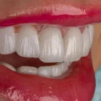 ایمپلنت  تخصصی     کامپوزیت دندان