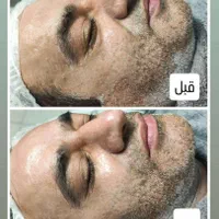 کاشت مو/لیزر مـوی زائد/فیلر بادی/ نخ بوتاکس/لاغری|خدمات آرایشگری و زیبایی|شیراز, طلاب|دیوار