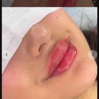 آموزش صفر تا صد ژل و بوتاکس