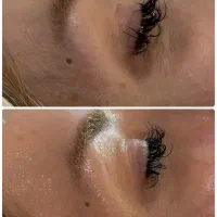 فیشال تخصصی دور چشم توسط پیراپزشک