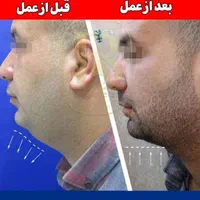 عمل. تزریق چربی صورت بیکینی لابیا پلاستی و بوتاکس|خدمات آرایشگری و زیبایی|رشت, جهاد|دیوار