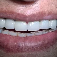 دندانپزشکی ترمیم زیبایی درمان ریشه روکش اطفال