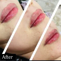 جوانسازی صورت،فیلر،بوتاکس