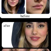 ژل لب و بوتاکس و زاویه سازی درمطب پزشک