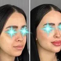 فیلر ژل بوتاکس فیلربادی کانتورینگ آنزیم