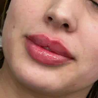 تزریق ژل لب وکانتورینگ(+بوتاکس رایگان|خدمات آرایشگری و زیبایی|کرمانشاه, |دیوار