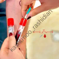 پی آر پی و مزوتراپی prp مو و ابرو|خدمات آرایشگری و زیبایی|اردبیل, |دیوار