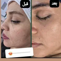 فیشیال و پاک سازی درمانی ۵۰۰ تومان گلستان،سعدی
