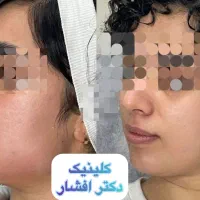 تزریق ژل لب فیلر بادی بیکینی بوتاکس زاویه مزو