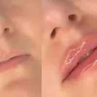 زیبایی بوتاکس فیلر