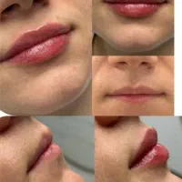 انجام ژل و بوتاکس با بهترین مواد اقساطی