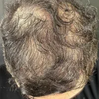 دیگه با ریزش موهات خداحافظی کن|آرایشی، بهداشتی، درمانی|کرج, عظیمیه|دیوار