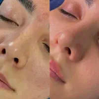 پاکسازی صورت درماپلینگ بابهترین مواد