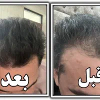 راهکار حرفه‌ای برای ریزش مو