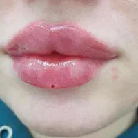 ژل لب|خدمات آرایشگری و زیبایی|اسلامشهر, شهرک مهدیه|دیوار