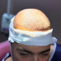 کاشت مو پر تراکم|خدمات آرایشگری و زیبایی|جهرم, |دیوار