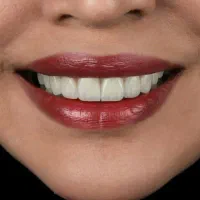 دندانپزشکی از دم قسط ایمپلنت کامپوزیت عصبکشی روکش|خدمات آرایشگری و زیبایی|خرمآباد, |دیوار