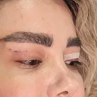 بلفاروبلاستی( جراحی پلک بدون رد بخیه)