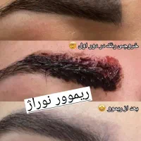 تخفیف ریمو تتو  با مواد گیاهی فقط تا آخر هفته