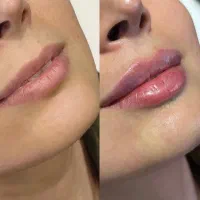تزریق ژل لب بوتاکس آنزیم لیفت مادلینگ پکیج۱۰ سی سی|خدمات آرایشگری و زیبایی|تهران, باغ فیض|دیوار